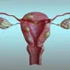 Should Uterine Fibroids be Removed?