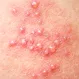 Can You Get Shingles After Being Vaccinated?
