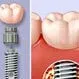 How Painful Are Dental Implants?