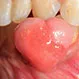 How are oral lesions treated?