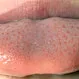 How Do You Get Rid of Transient Lingual Papillitis?