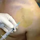How Is a Shoulder Arthrocentesis Performed?