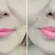 Which Lip Filler Is the Best?
