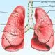 What Causes Nodules in the Lungs?