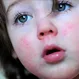 What is the Main Cause of Scarlet Fever?