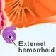 How Long Do Thrombosed External Hemorrhoids Last?