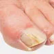 How Do You Get Rid of Yellow Toenails?