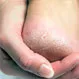 What Is the Best Foot Callus Remover?